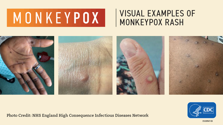 Monkeypox Information UCI Student Health Center